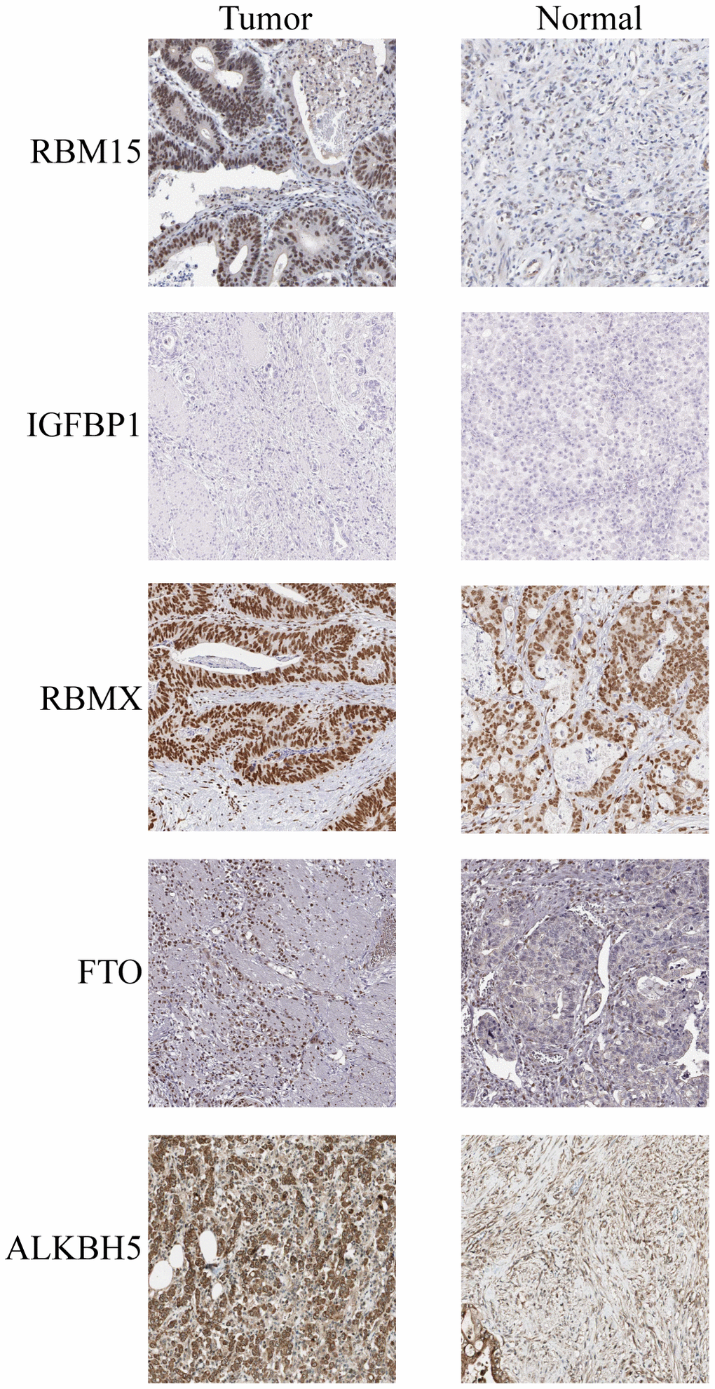 IHC analysis of five m6A modulators in stomach adenocarcinoma tissues and adjacent normal tissues.