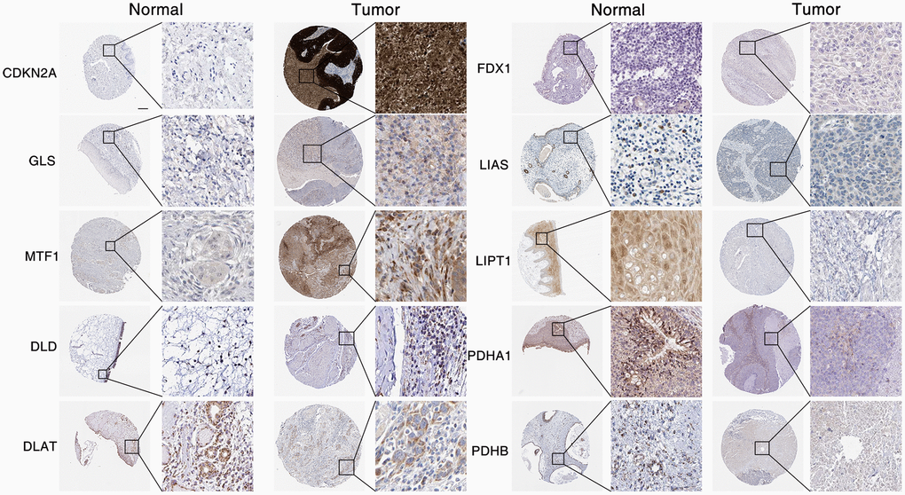 Expression of CAGs in HNSC. CAGs expression data from The Human Protein Atlas database in tumor with or normal tissue were measured by immunohistochemical staining. Scale bar, 20 μm.
