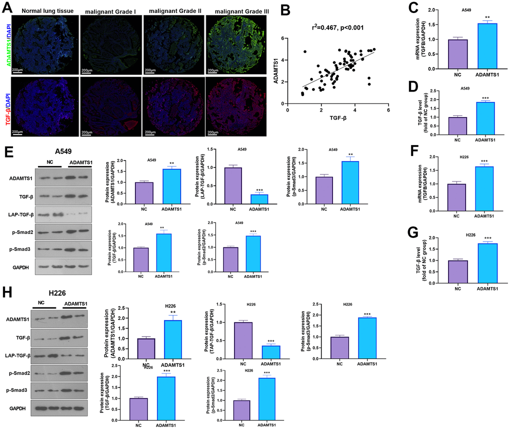 ADAMTS1 positively regulates the expression of TGF-β in NSCLC cells or tumor tissues. (A) Immunofluorescence was used for detecting ADAMTS16 and TGF-β in NSCLC tissues from different grades. Scale bar=200 μm. (B) qRT-PCR showed the mRNA expression level of TGF-β in lung tissues and adjacent normal tissues. (C) qRT-PCR showed the mRNA expression level of TGF-β in A549 cells overexpressing ADAMTS1. (D) Secretion of TGF-β protein in A549 cells detected using ELISA. (E) Protein expressions of TGF-β, LAP-TGF-β, and p-Smad2/3 in A549 cells were detected using Western blot. (F) qRT-PCR showed the mRNA expression level of TGF-β in H226 cells overexpressing ADAMTS1. (G) Secretion of TGF-β protein in H226 cells detected using ELISA. (H) Protein expressions of TGF-β, LAP-TGF-β, and p-Smad2/3in H226 cells were detected using Western blot. **PP