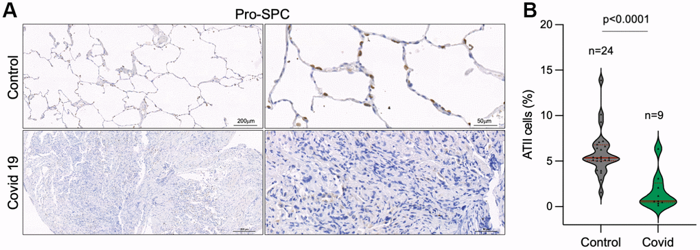 Decreased number of alveolar type II cells in the lungs of COVID-19 patients. (A, B) Representative images of prosurfactant protein C (pro-SPC) immunostaining, a marker of alveolar type II cells (ATII) (A) and quantification of pro-SpC positive cells in the lungs of control and COVID-19 patients (B) Statistical significance was assessed using Student’s t test and the p-value is indicated.