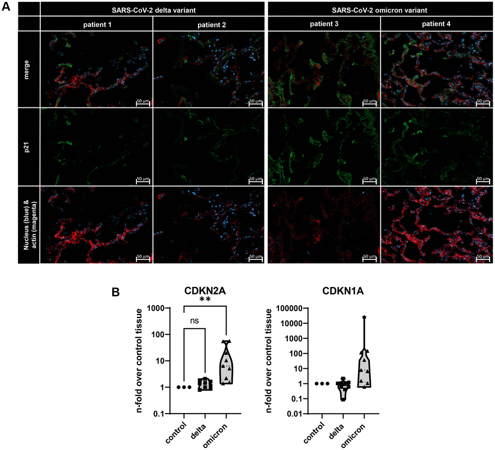 (A) Immunofluorescence staining of lungs from deceased COVID-19 patients. Lung tissue was stained with p21 (green), actin (red), and nuclei (blue) staining. Scalebar indicates 50 μm. (B) Gene expression of senescence marker CDKN1A and CDKN2A in three distinct lung biopsies of three deceased patients per SARS-CoV-2 variant. Expression levels are displayed normalized to healthy lung tissue from healthy lung transplantation tissue. P calculated by ANOVA with Kruskal-Wallis multiple comparisons tests (B), **p 