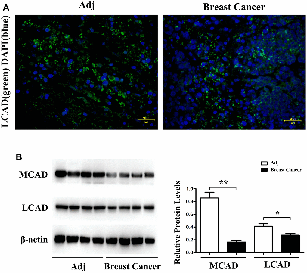 LCAD (long-chain Acyl-CoA dehydrogenase) (green) immunofluorescence staining in adjacent tissue and breast cancer (A). Western blotting demonstrates that MCAD (Medium-chain acyl-CoA dehydrogenase) and LCAD (long-chain Acyl-CoA dehydrogenase) expression level is significantly higher in adjacent tissue than in breast cancer (B). n = 32 (4 fields each from 8 mice). Scale bar=50 μm. **, P