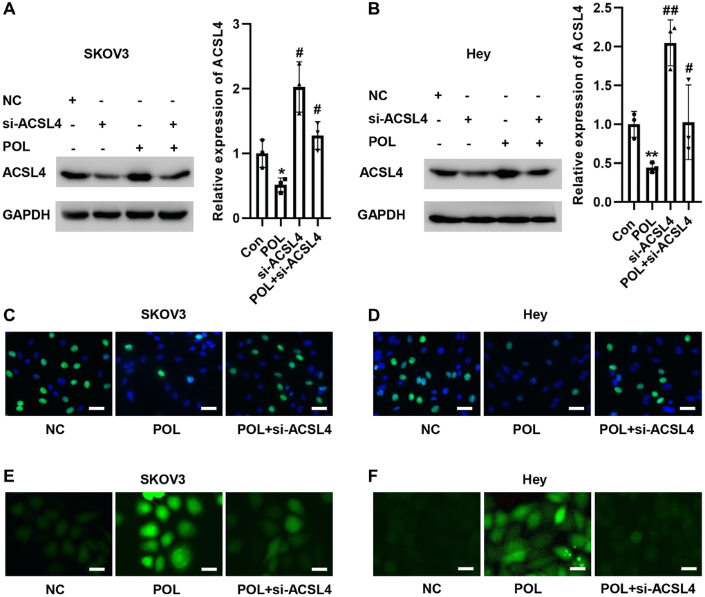 Knockdown of ACSL4 reverses POL-induced ferroptosis in ovarian cancer cells. Western blot assay revealed that POL-induced high expression of ACSL4 was reversed to some extent by si-ACSL4 in SKOV3 (A) and Hey (B) cells. EdU staining showed that POL decreased the proliferation of SKOV3 (C) and Hey (D) cells, and si-ACSL4 could reverse this effect (20×). Silencing ACSL4 also reduced POL-induced lipid peroxidation in SKOV3 (E) and Hey (F) cells (40×). *P **p #P ##P 