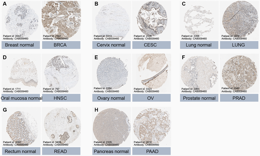 Protein expression of GLI1 in normal and tumor tissues. Immunohistochemical staining of normal and tumor tissues in the HPA database. (A) Breast normal, BRCA. (B) Cervix normal, CESC. (C) Lung normal, LUNG. (D) Oral mucosa normal, HNSC. (E) Ovary normal, OV. (F) Prostate normal, PRAD. (G) Rectum normal, READ. (H) Pancreas normal, PAAD.