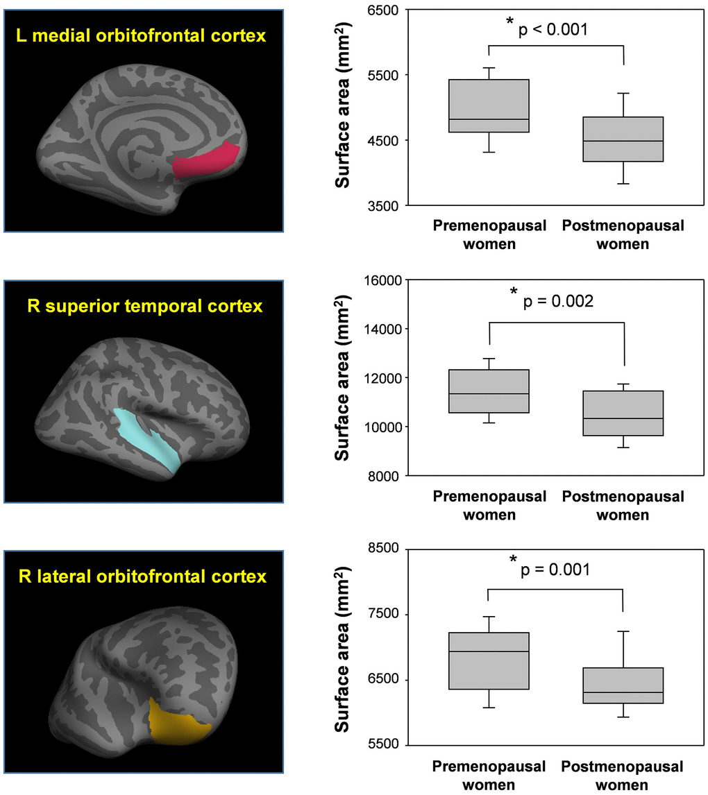 Reduced surface areas in postmenopausal women compared to premenopausal women. Postmenopausal women showed significantly reduced surface areas in the left medial orbitofrontal cortex (mOFC), right superior temporal cortex (STC), and right lateral orbitofrontal cortex (lOFC) compared to premenopausal women. *Meet Bonferroni-corrected significance level.