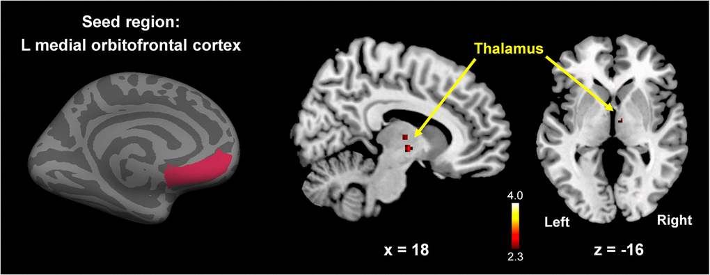 Between-group comparison map (premenopausal women vs. postmenopausal women) of the left mOFC functional connectivity. Postmenopausal women showed significantly lower functional connectivity between the left mOFC and right thalamus compared to premenopausal women (p p 