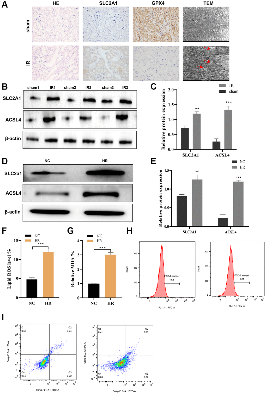 SLC2A1 and ACSL4 were overexpressed in AKI and promote HK-2 cell apoptosis. (A) HE and immunohistochemistry of SLC2A1, GPX4 and TEM in renal ischemia-reperfusion injury model; (B) The protein level of SLC2A1 and ACSL4 in renal ischemia-reperfusion injury model and normal control model was verified by Western blot; (C) Relative quantification of SLC2A1 and ASCL4 in B; (D) The protein level of ACSL4 and SLC2A1 in HR induced AKI model and was verified by Western blot; (E) Relative quantification of these proteins in D; (F) The lipid ROS level was verified in HR induced AKI model and normal control model; (G) The MDA level was verified in HR induced AKI model and normal control model; (H, I) The apoptosis rate was verified in HR induced AKI model and normal control model. *p **p ***p 
