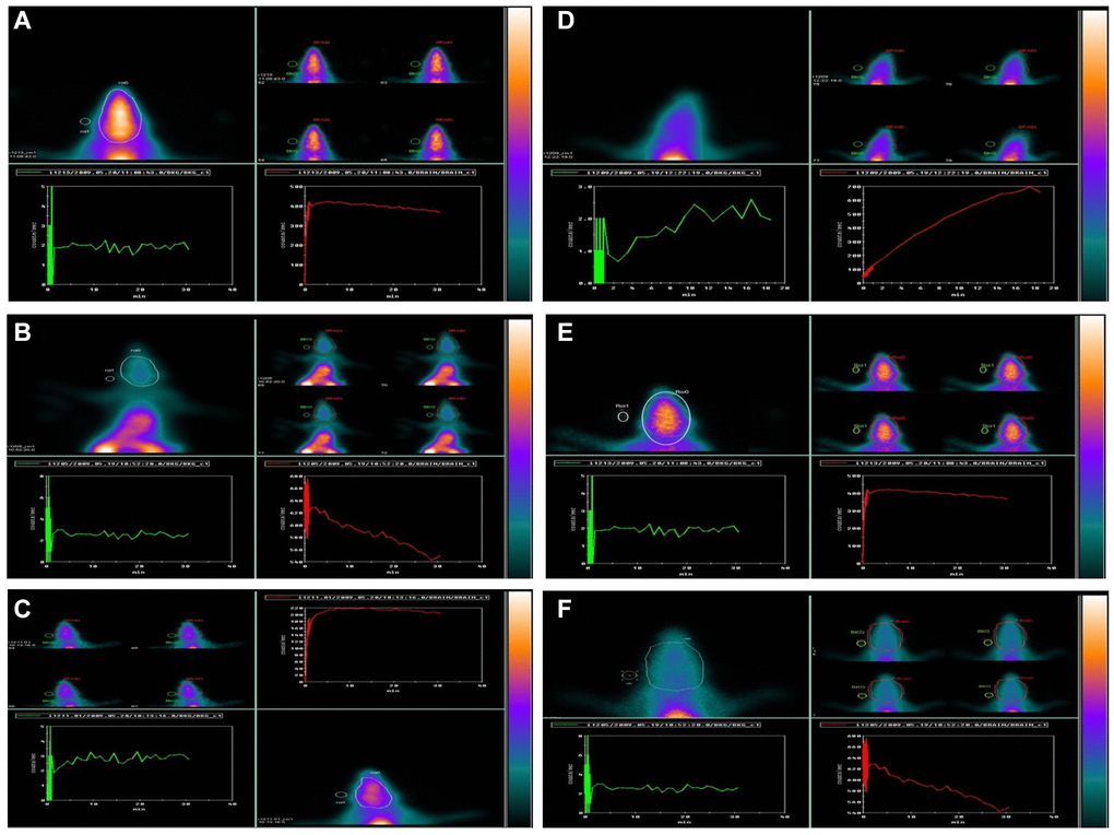 Effect of GNL on D-gal-induced cognitive impairment mice by using 99mTc-HMPAO (brain) animal imaging. Composite 0–60-min images, time-activity curves, and regions of interest (ROIs) are shown: Group I: (A), Group II: (B), Group III: (C), Group IV: (D), Group V: (E), and Group VI: (F). Brain ROI. Abbreviations: BG: background; WB: whole body.