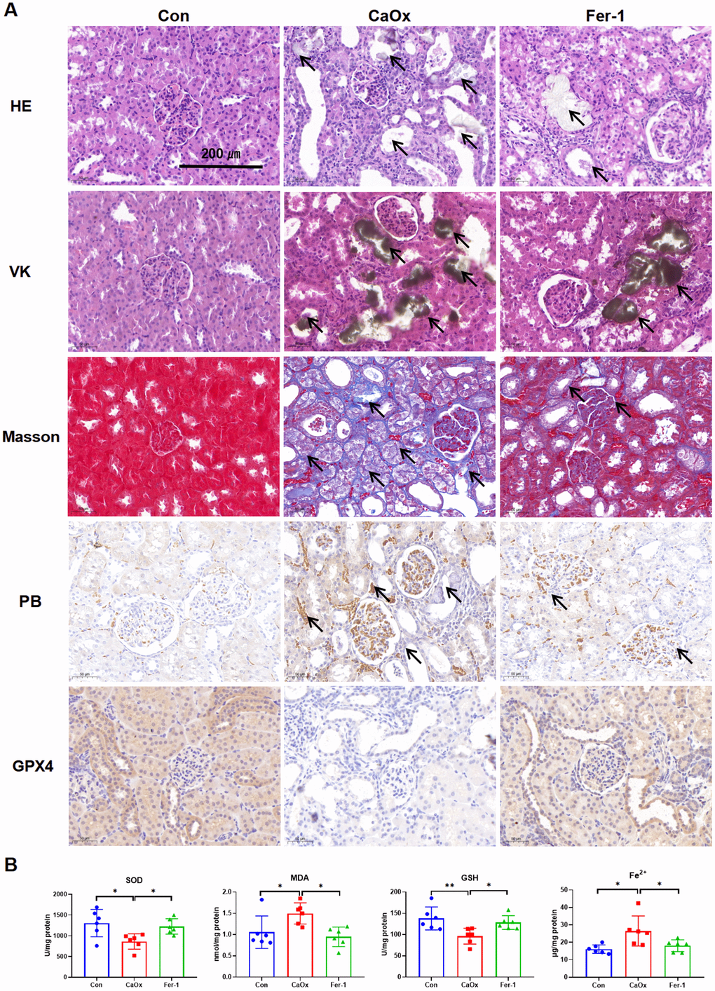 Fer-1 reduces CaOx crystal deposition and kidney injury in CaOx nephrolithiasis rat models. (A) Pathological sections including HE, VK, and Masson staining show the degree of kidney injury, crystal deposition, and kidney fibrosis; PB staining shows the Fe3+, while IHC staining shows GPX4 protein expression in different groups (magnification×20; scale bar, 200 μm). (B) SOD, MDA, GSH, and Fe2+ levels are detected in different groups (mean ± SD, n = 6, *P P 