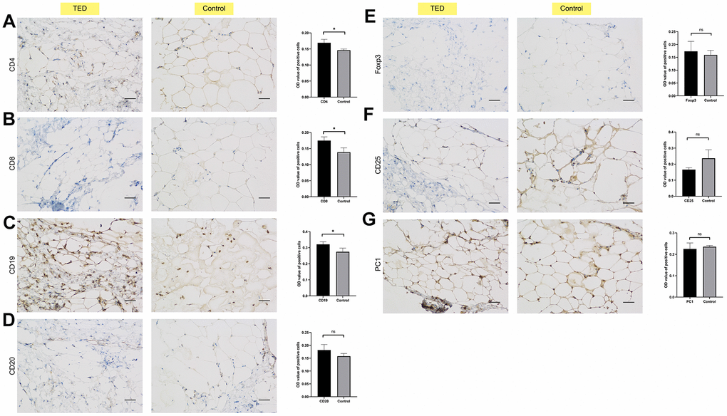 Immunohistochemical validation of immune cell infiltration. Identifying the differences in immune cell biomarkers and their presence in periorbital adipose tissue of thyroid ophthalmopathy patients and normal controls (x200). (A) CD4; (B) CD8; (C) CD19; (D) CD 20; (E) Foxp3; (F) CD25; (G) PC1. *P P P 